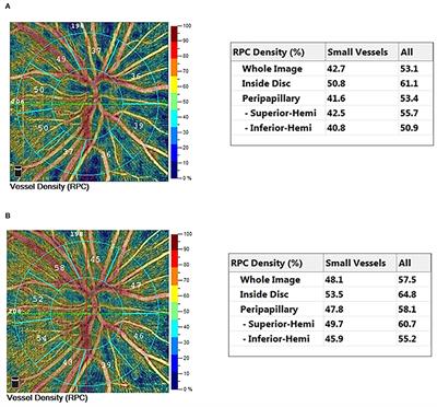 Improved Retinal Microcirculation After Cardiac Surgery in Patients With Congenital Heart Disease